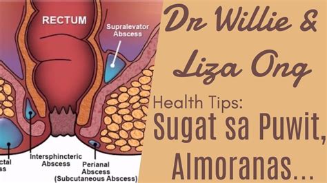 Sugat sa Puwit, Almoranas, Fissure at Kanser – ni Doc Ramon Estrada ...