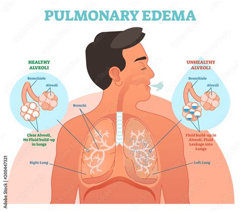 Pulmonary edema, lung problem vector illustration diagram Stock Vector ...