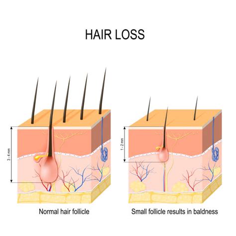 Alopecia Areata: Causes, Symptoms, and More - REPC