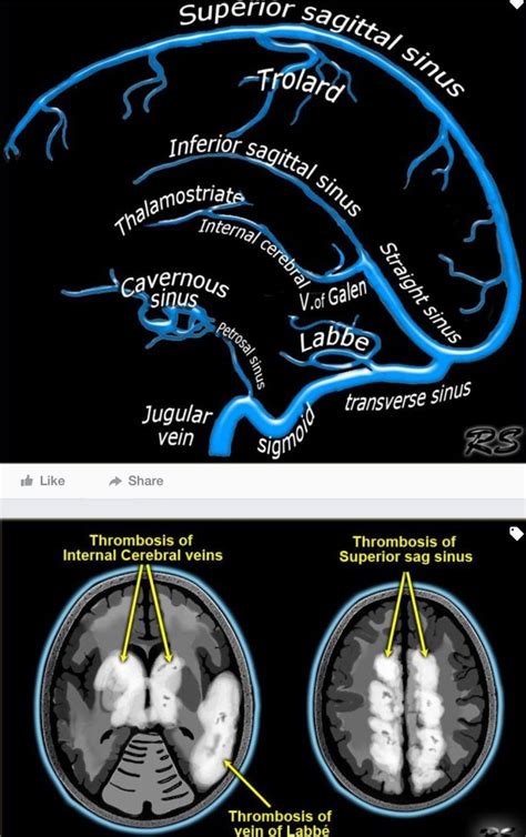 Cerebral Venous Sinus