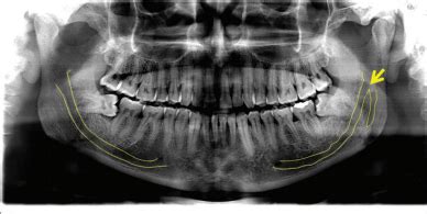 Prevalence and classification of anatomical variations of mandibular ...