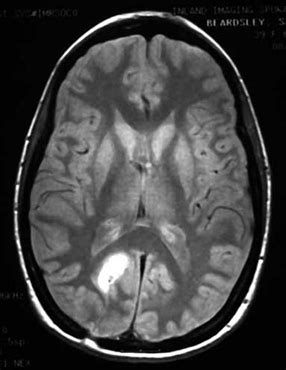 Brain Mri Scan Tumor