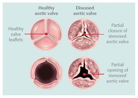 Aortic Stenosis Anatomy Diagnosis Treatment - The Valve Clinic