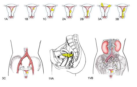 Pathology Outlines - Staging-carcinoma and carcinosarcoma