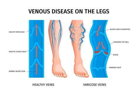 What is chronic venous insufficiency? - NexGen Orthopedics