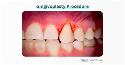 Gingivoplasty Explained: Benefits, Procedure, & Aftercare Tips - Share ...