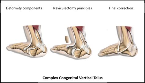 Naviculectomy as a Third Way Beyond Minimally Invasive and Extensive ...