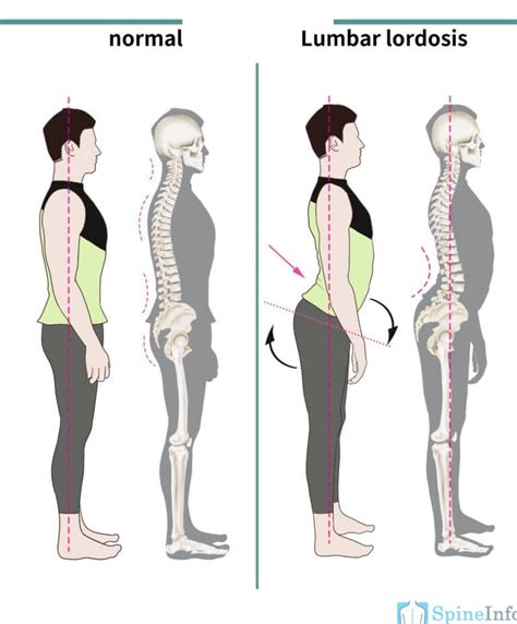 Lumbar Lordosis: Definition, Causes, Symptoms, Diagnosis, and Treatment ...