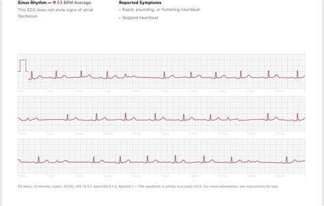 Heart flutter/feeling of skipped beat. Background in comments : r ...