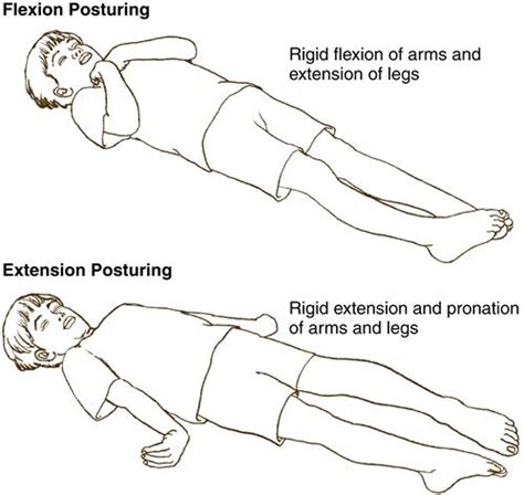 Flexion Vs Extension