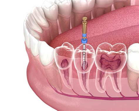 Six Things to Know About Root Canals | Dental Health Associates