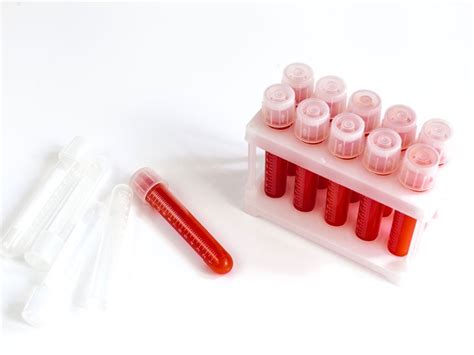 Antimitochondrial Antibody Test: Purpose, Procedure, and Results