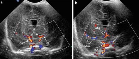 Essentials of Transcranial Doppler Ultrasound | SpringerLink