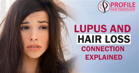 Lupus And Hair Loss – Connection Explained #hairtransplant # ...