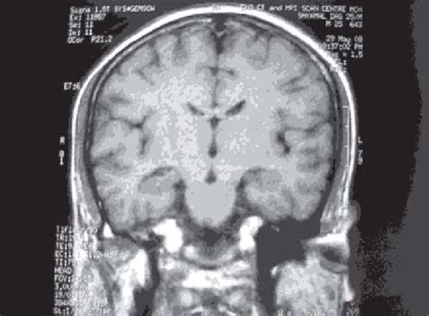 MRI showing prominent temporal horn. | Download Scientific Diagram