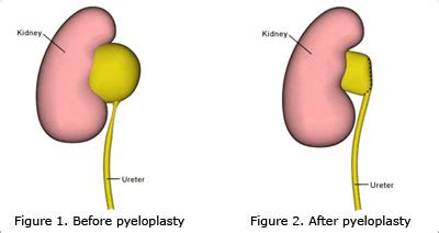 PUJ Obstruction – WA Urology