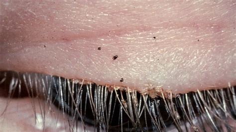 Eyelash Lice: Symptoms and Treatment Options