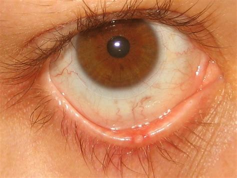 👉 Stye - Pictures, Contagious, Symptoms, Causes, Treatment (November 2021)