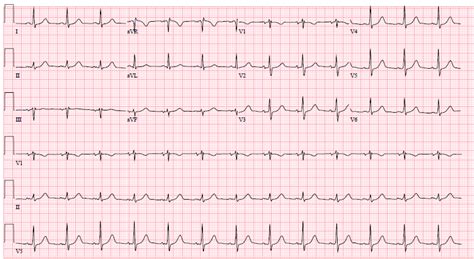 Dr. Wes: EKG Du Jour #30: ECG O.M.G.