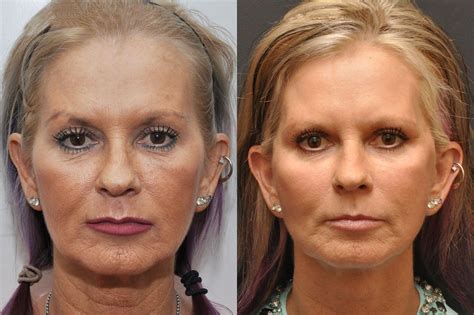 Minilift / Facelift Photos | Cincinnati, OH | Patient 7001