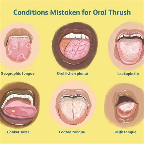 Favorite Tips About How To Get Rid Of Geographic Tongue - Settingprint