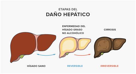 Higado-Cirrosis: Enfermedad, Síntomas y Causas