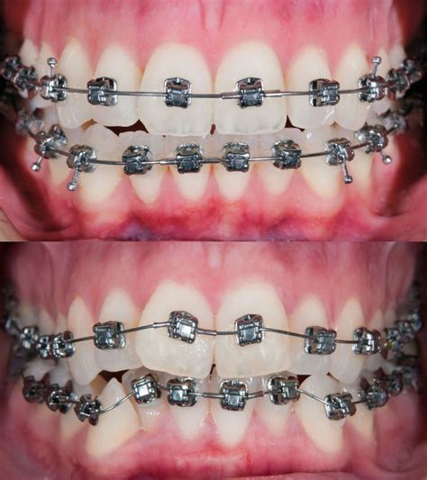 Stages of Change in Braces - Orthodontic Associates