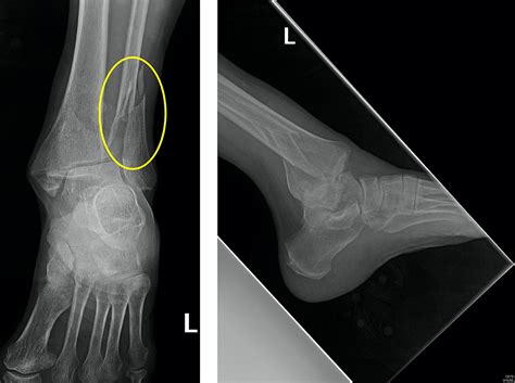 Fixation Of Posterior Lip Ankle | Sitelip.org