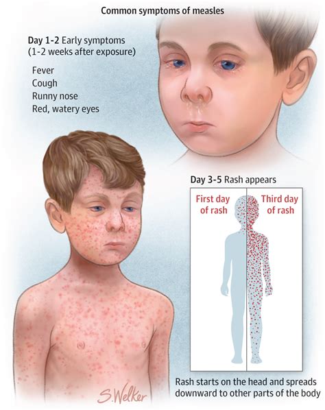 Recognizing Measles | Infectious Diseases | JAMA | JAMA Network