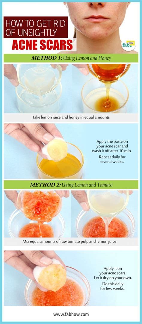 How to get rid of acne scars fast | Teamore