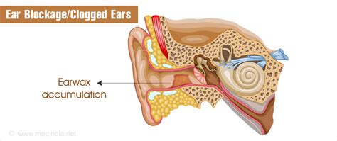 Clogged Ears (Stopped Up Ear): 7 Instant Ways to Unclog/Fix