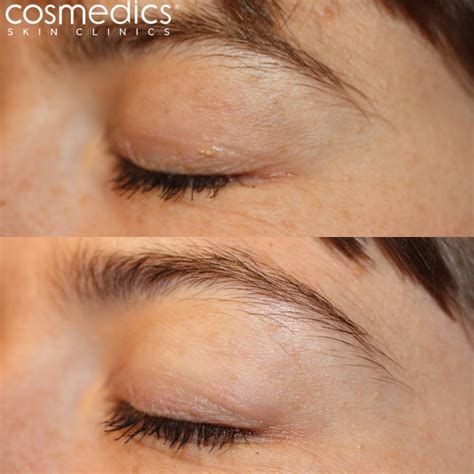 Xanthelasma Eyelid Cholesterol Treatment | Cosmedics Skin Clinics