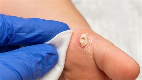 Warts | Dermatology | OneWelbeck Skin Health & Allergy