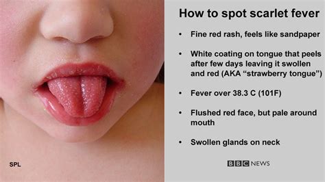 Scarlet fever case numbers on the rise in Northern Ireland - BBC News