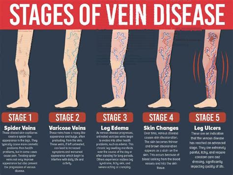 VENOUS DISEASE It's More Than Just Varicose Veins • Southwest Florida's ...