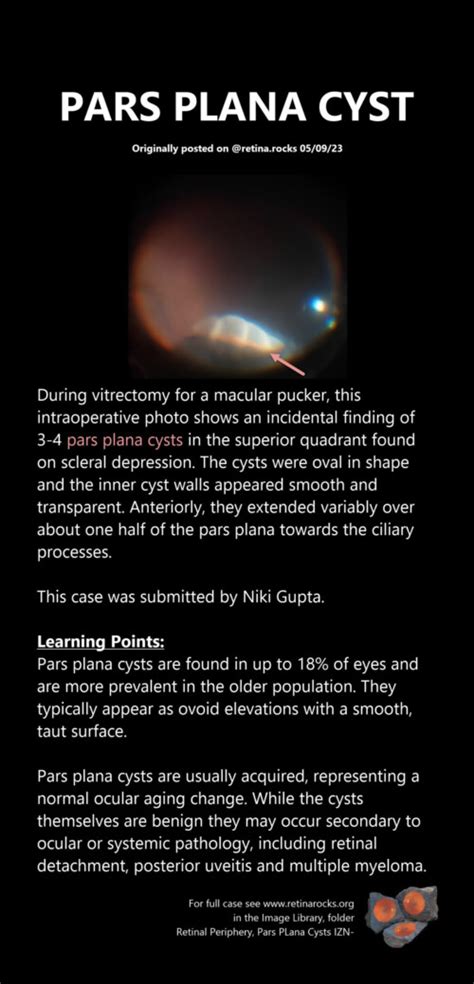 Vitreous, Vitreoretinal Interface Abnormalities, and Peripheral Retina ...