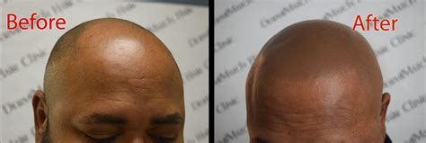 Finasteride Side Effects - DermiMatch Hair Clinic | Scalp ...