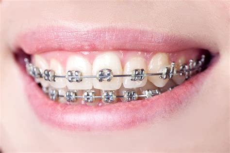 How Much Do Teeth Braces Cost? Australia Dental