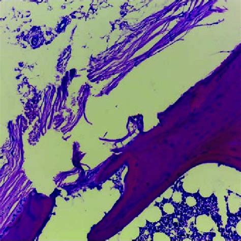 Fracture of hyoid bone with hemorrhage; hematoxylin-eosin 100X ...