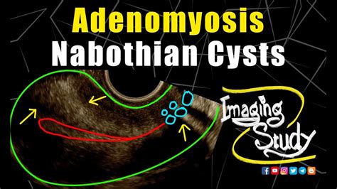 Adenomyosis With Nabothian Cysts Ultrasound Tvs Case 255 Youtube | Free ...