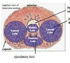 Median prostatic lobe lying in between the three ducts-prostatic ...