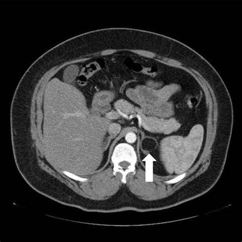 Omentopexy after gastrectomy. | Download Scientific Diagram