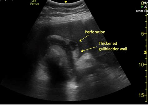 Case 32: Perforated Gallbladder - UCSD Ultrasound