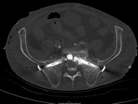 Pelvic fracture fixation: Fixation of Sacroiliac joint diastasis using ...