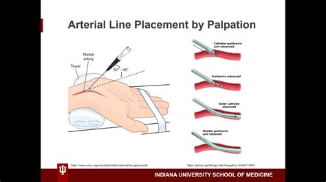 Arterial Line Placement By Palpation by Nicole Villiger, MD Candidate ...