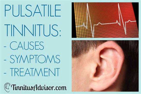 Pulsatile Tinnitus - Causes, Symptoms and Treatment