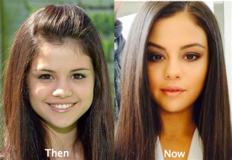 Selena Gomez Plastic Surgery Before and After Photos