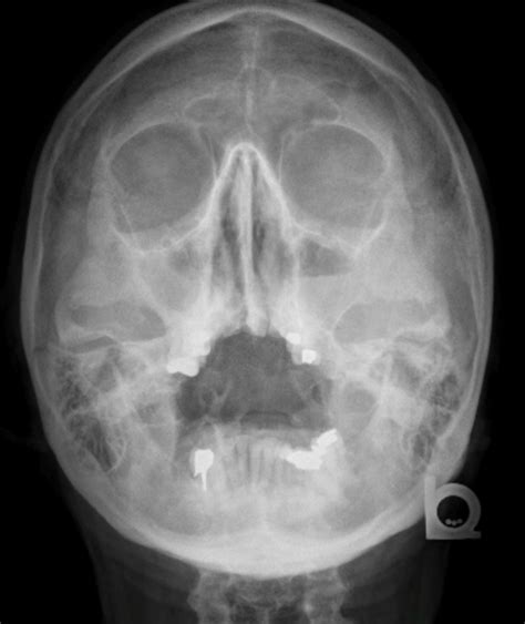 Sinusitis/Mastoiditis – Undergraduate Diagnostic Imaging Fundamentals