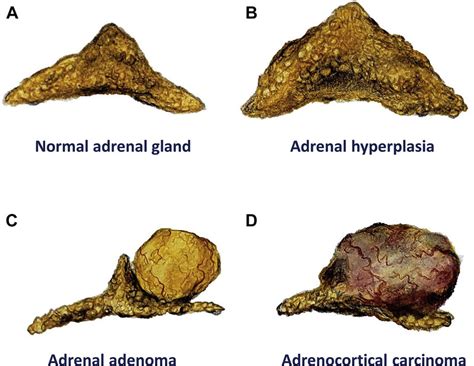 Adrenal Cortical Adenoma Histology