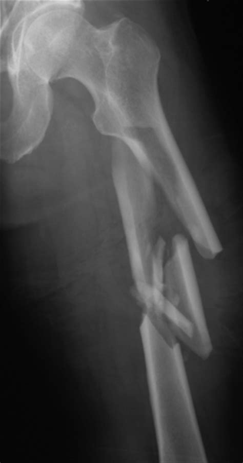 Pertrochanteric Femur Fracture